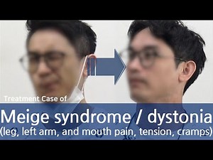 Meige syndrome / Dystonia (facial, oromandibular, eyes, tongue, neck, half of body) / 디스토니아 치료사례