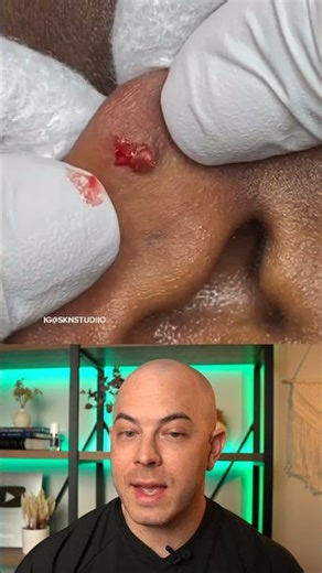 Doctor reacts to infected cyst on the ear! #dermreacts #doctorreacts #earcyst