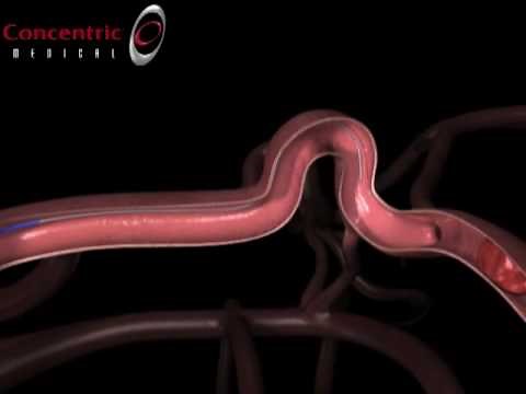 Merci Retrieval System X Series Animation
