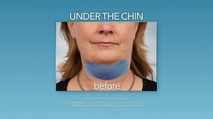 Zeltiq Aesthetics CoolSculpting TV Spot, 'Double Chin'