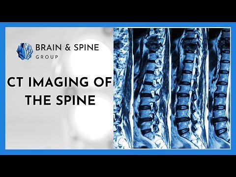 CT Imaging of the Spine