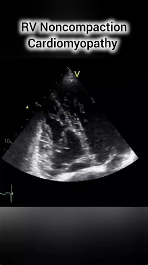 📌 RV NonCompaction - For detailed Echo Cases Must Visit this Echo channel 👉 https://youtube.com/@drmusmanjaved #echocardiogram #echocardiography #echo #ecg #ekg #cardiology #cardionotes #heart #medical | CardioNotes