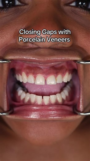 Closing Gaps with Porcelain Veneers for a Perfect Smile