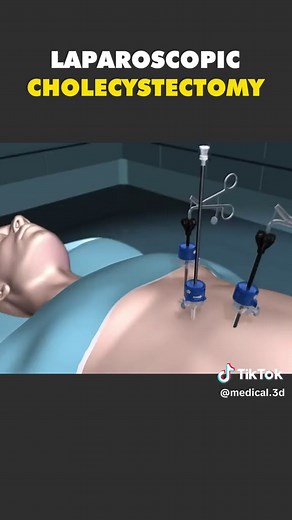 Laparoscopic Cholecystectomy Surgery 3D Animation #cholecystectomy #cholecystitis #cholecystectomyrecovery #cholecystectomy💉📚🏥 #cholecystectomyproblems #cholecystitis? #laparoscopicsurgery #laparoscopiccholecystectomy #medical3danimation #3dmedicalanimation