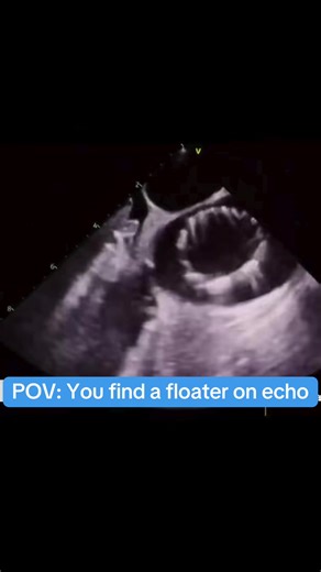 You find a floater on echo, what do you do? 🫣 #Medtok #funny #cardiology #subscribe #followme