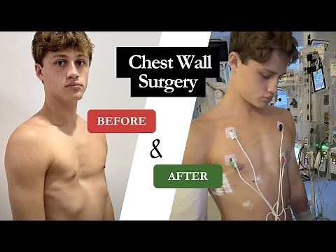 Before & After | Brady's Pectus Excavatum Surgery