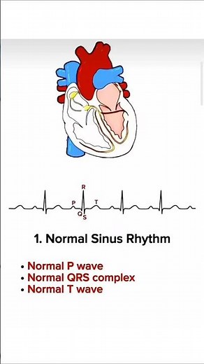 🫀 ECG Rhythms Made Easy: 9 Essential Heart Rhythms Every Healthcare Professional Should Know
