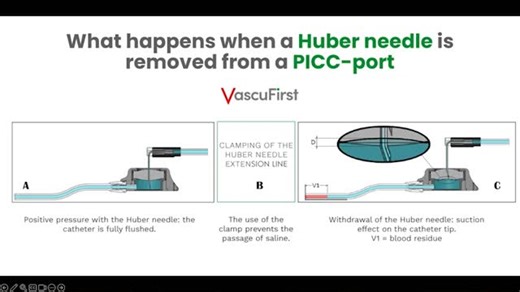 TheVascularGuy on Instagram: "traumpunkts uznemsanas - Ports and closing.mp4"