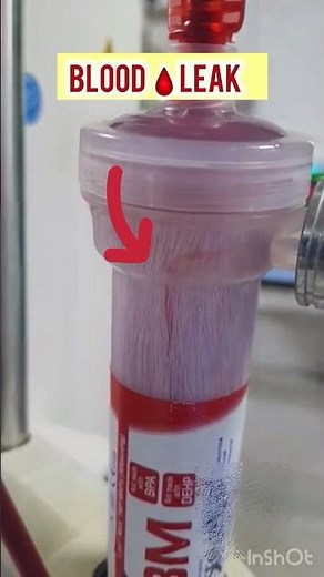 Blood leak from during dialysis || during dialysis blood leak dialyzer #dialysis #nephrology #video