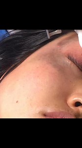 5.6K views · 70 reactions | Removal of pigmentation from face #plasticsurgery #cosmeticsurgery #dratiq #ReconstructiveSurgery #Laser | Dr. Atiq's Plastic, Aesthetic, Maxillofacial & Reconstructive Surgery | Facebook