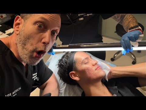SILIKON FILLER FOR ACNE SCARS TO GIVE TRUE AND PERMANENT VOLUME LONG TERM RESULTS | Dr. Jason Emer
