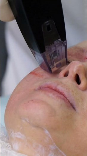 Get rid of sagging eyelids and dark circles with Morpheus8 microneedling RF lifting!