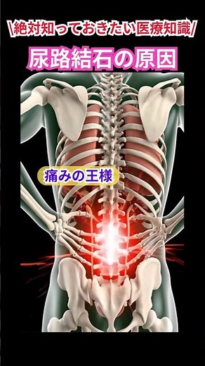 ✨【痛みの王様・尿路結石】絶対に知っておきたい医療知識✨「人生最大の痛み」を味わいたくない人は必読＆保存推奨✨#尿路結石 #健康 #医療 #看護師 #医療従事者