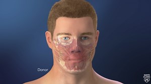 Video Shows Animation Of Man's Successful Face Transplant
