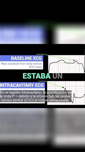 Central Line Nightmare: Anatomical Challenges Explained! #shorts
