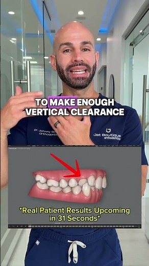 Fixing a crossbite with Invisalign. Real patient results in 6 months!!