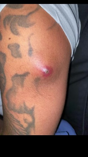 #acne #acnegrave #abscesso #abscessdraining #fisioterapia #fh♿️ | acne