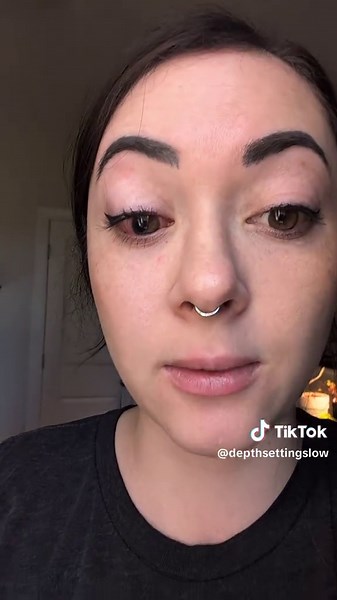 Understanding Drainage Devices for Glaucoma Treatment