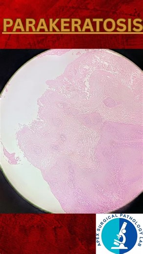 Dr. Zeba Nisar on Instagram: "Spotting Parakeratosis in Histopathology Parakeratosis refers to retention of nuclei in the stratum corneum, often seen in conditions like psoriasis or chronic dermatitis. 🔬 This section beautifully highlights the presence of nuclei where the keratin layer should normally be anuclear. A key clue in dermatopathology reports! (parakeratosis, histopathology, dermatopathology, stratum corneum, keratin, microscopy, skin pathology) #Parakeratosis #Histopathology #Dermato