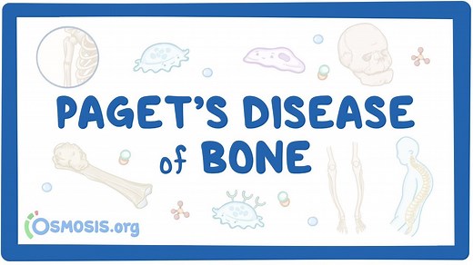 Paget disease of bone: Video, Causes, & Meaning | Osmosis