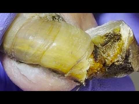 These toenails are so black! Cut off ingrown toenail【Pedicure King】
