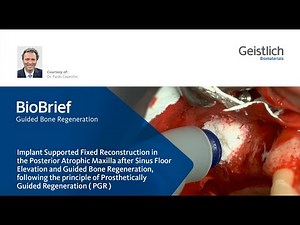 Major Bone Augmentation - Prosthetically Guided Regeneration (PGR) in the posterior maxilla.