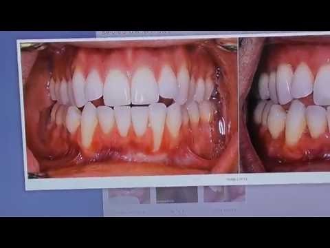 Gum Recession & Orthodontics: They're Connected!