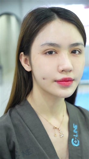 Mũi đẹp phải đến Cline | Cline Clinic #cline #clineclinic
