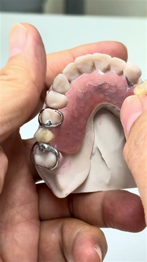 Traditional partial!