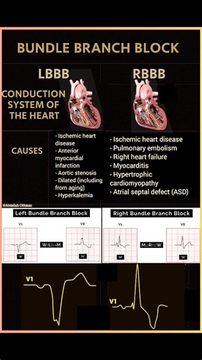 Abdallah Othman on Instagram: "Bundle Branch Block (LBBB & RBBB), detailing the conduction system, key causes, and ECG patterns. 👍 Like | 📤 Share | 👥 Tag a colleague | ⏳ Save for later. #Cardiology #Healthcare #BundleBranchBlock #ECG #MedicalEducation"