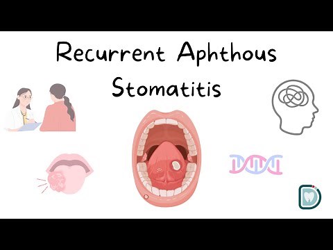 Understanding Recurrent Aphthous Stomatitis (RAS) or Oral Aphthous Ulcers