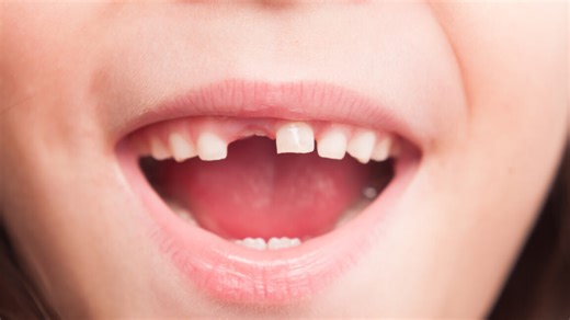 RFK Jr’s plan to ban fluoride supplements will “hurt rural America,” dentists say