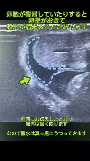 エコーの見え方 脾臓 腸管 副腎 卵胞 腹水