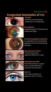 Congenital Anomalies of Iris #optometristbd #iris | Optometrist BD