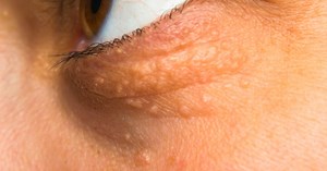 Colesterol alto tem sintomas? Veja como identificar e quando procurar ajuda