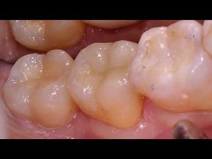CEREC Dental Crowns by Ellicott City Dentist