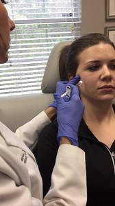 Nonsurgical Cheek Augmentation