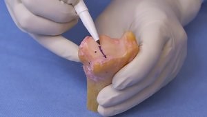 Simplified Arthroscopic Glenoid Reconstruction Surgical Technique and Rationale with Dr. Ivan Wong