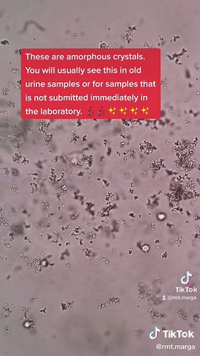 Reply to @raymondabadandi Maybe this explanation can help a little. #microscope #themedtechlab #urine #fypシ #fyp #medtechstudent #medtech #mls