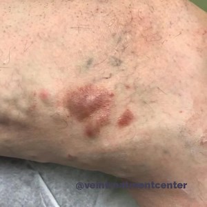 1.9K views | These images show venous stasis dermatitis, also known...