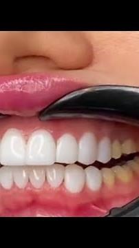 Female's Teeth | Teeth Smile Design
