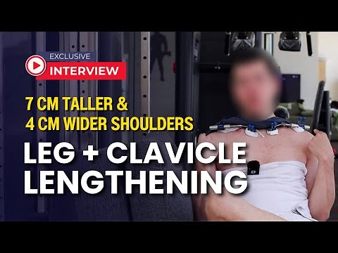 TALLER & BOLDER | Leg and Clavicle Lengthening: A Life-Changing Experience