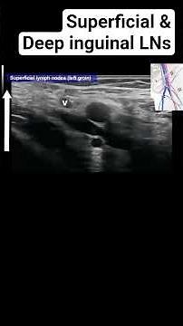 How to differentiate deep and superficial inguinal lymph nodes in the left groin using ultrasound?