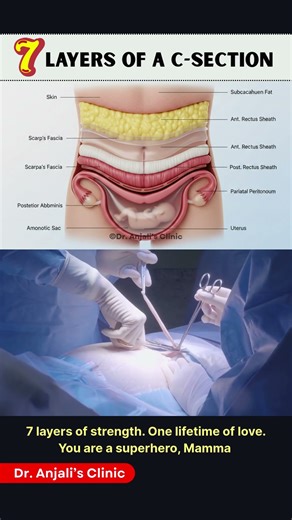 7 Layers of a C-Section: What Actually Happens?