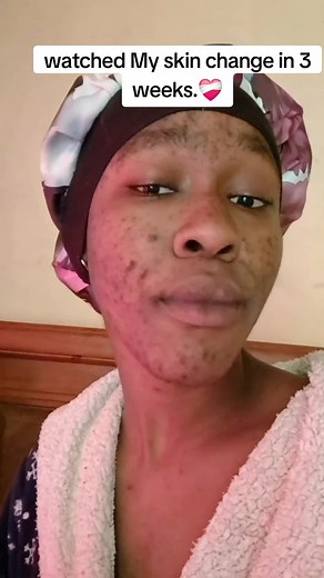My Skin Transformation in 3 Weeks | Oratane Journey