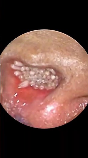 Dừng ngay việc dùng TĂM BÔNG ngoáy tai! 🚫👂