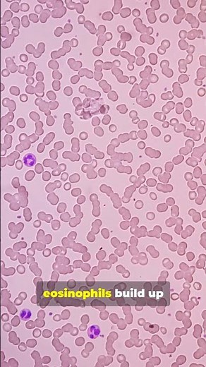 What is Eosinophilic Esophagitis?
