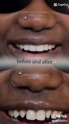 Affordable Composite Veneers for a Stunning Smile
