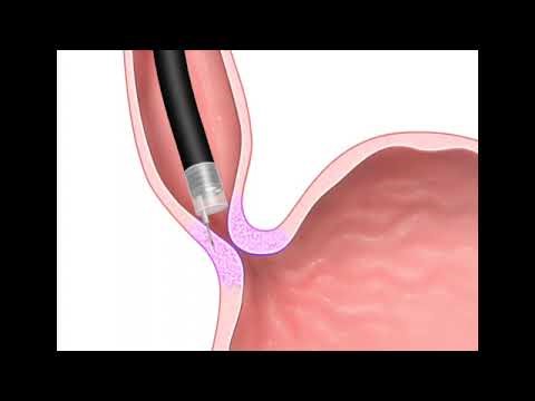 Podcast-36. EGD-Botox injection