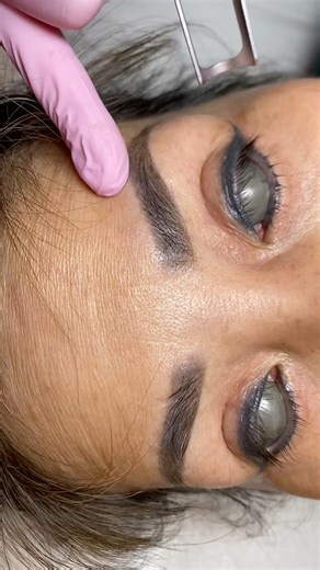 Eyeliners tattoo removal process #denvercolorado #lasertattooremoval #eyelinertattooremoval
